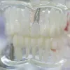 Dental Implants Houston Tx  — Everything You Need To Know About Dental Implants