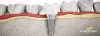 It Is Now Easier Than Ever to Have the Best Dental Implants in India