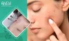 best-doctor-for-acne-scar-removal-in-bangalore.jpg