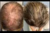 Hair Loss &amp; Nail Disorders Treatment Dubai &amp; Abu Dhabi | Nail Fungal Infection
