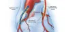 Best Heart Bypass Surgery Hospitals in Delhi - TAVR Cardiac Surgery