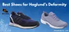 Best Shoes for Haglund’s Deformity