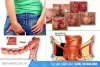 Bị đau hậu môn có phải bị bệnh trĩ hay không?