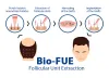 Hair Transplant Cost in Hyderabad | Redefineu