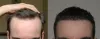 Bio-FUE Hair Transplant | Best Hair transplant in Tirupati
