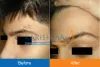 Birthmark Removal Treatment in Pune | Birthmark Removal Near Me