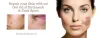 Laser Birthmark Removal In Noida