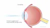 Best Lasik Surgery in Hyderabad | How much Lasik Surgery Costs?
