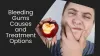 Bleeding Gums Causes and Treatment Options 
