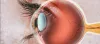Stem Cell Therapy For Optic Nerve Hypoplasia in India