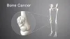  types of Bone Cancer