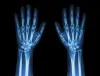 Fracture Bracing and Shortening of the Fractured Bone