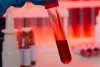 How Does a Bone Marrow Transplant Work?