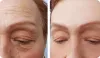 Dysport vs Botox: Is there a difference?