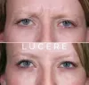 Botox Treatment to Minimize Wrinkle and Lines