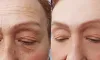 Cryocorrect For Melasma