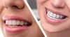 bestdentist [licensed for non-commercial use only] / What happens when you choose Invisalign instead of braces