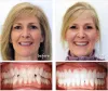 Orthodontic Braces Options For Adults