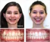 Orthodontic Braces For Teens | Children Braces | Pure Orthodontics