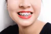 Yoursmile.sg &bull; Get teeth straightening tips from dental experts!