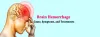 Best Brain Hemorrhage Surgery in Gurgaon
