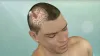 Minimally Invasive Brain Surgery / Keyhole Craniotomy - Prof Dr Khalid Mahmood