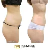 What Do You Need to Know About Brazilian Butt Lift Surgery?