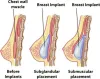Breast Augmentation Seattle | Breast Implant Surgeon
