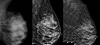 What is Breast Chemosynthesis? | cancer specialist in Delhi