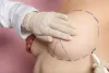 Breast Lift Surgery Dubai | Breast Lift In Dubai - Dr. Adnan Tahir