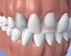 Replacing missing tooth - Dental Bridges / Dental Dentures Treatment