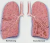 Bronchiectasis Relief can be found in Natural Treatment - Herbs Solutions By Nature