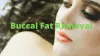 Buccal Fat Removal - Costs,Benefits,Risks,Procedure