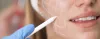 Buccal Pad Fat Removal Procedure