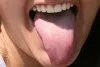burning-mouth-syndrome.jpg