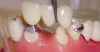 Crown & Bridge Treatment in Race Course|crown & Bridges in Coimbatore