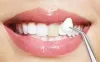 Veneersdentist | Dental Veneers: Benefits and Procedure