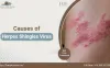 Herpes Shingles Virus and its Cause