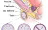 Can Azoospermia be Treated?