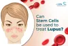 Can Stem Cells be Used to Treat Lupus?