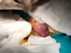 Early Stage Penile Cancer