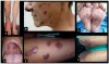 CAUSES AND SYMPTOMS OF KAPOSI’S SARCOMA