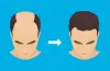 Female Hair Transplant In Delhi, India  Hair loss is a common issue that affects people of 