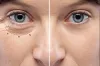 Eyelid surgery in Chandigarh