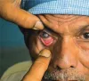 Charity Cataract Surgery UK, Charity Cataract Treatment