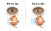 Can Cataract Lenses be Replaced?