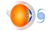 Cataract Surgery in Hyderabad | How much does Cataract Surgery Costs?