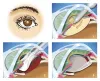 Refractive lens exchange