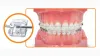 Ceramic braces for teeth 
