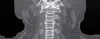 Cervical Spine 6View X Ray - 80% Off on Radiology Services - Cura4U